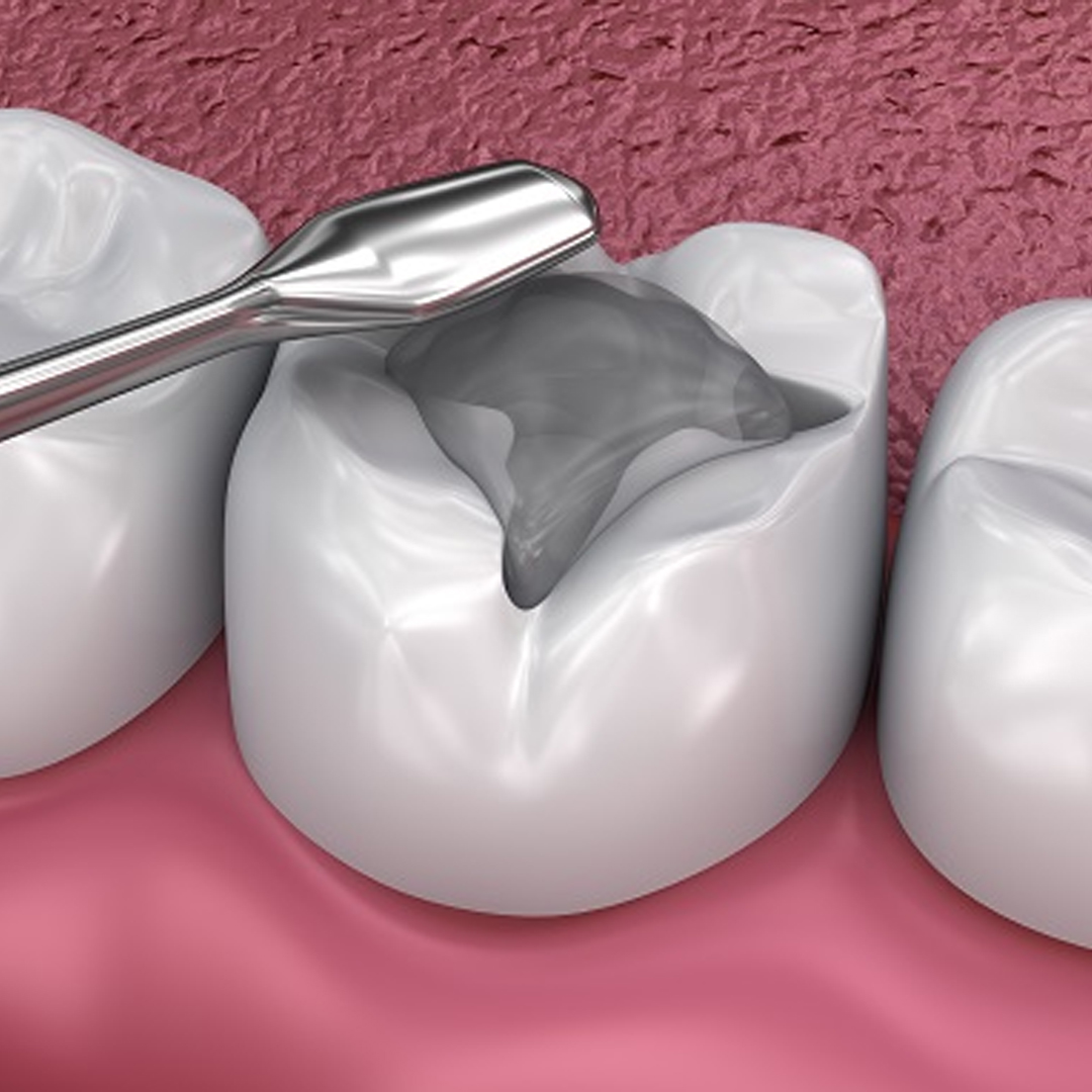 Dental Filling available in online  pharmacy qatar, doha 